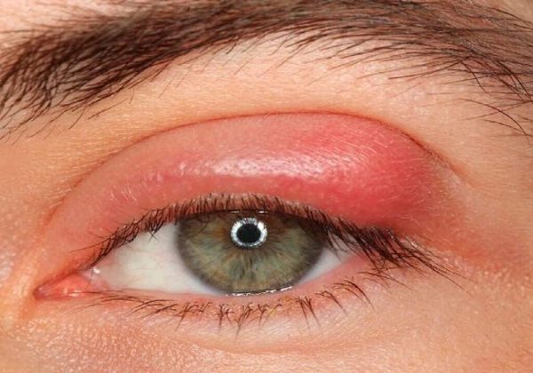Eyelash And Its Side Effects And Risks Aalipayam